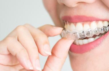 6 razlogov, zakaj je Invisalign boljši od klasičnih zobnih aparatov!